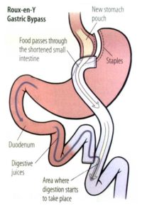 roux-en-gastric